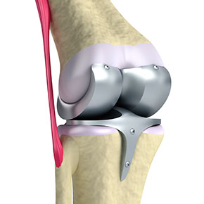 Knee-Replacement